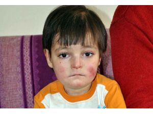 Milyonda bir görülen hastalık Yakup'u eritiyor