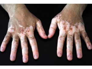 Vitiligo tedavisinde umut ışığı