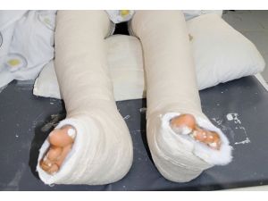 Sigara içenin kırığı geç iyileşiyor