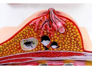 Meme kanseri tedavisinde yeni umut