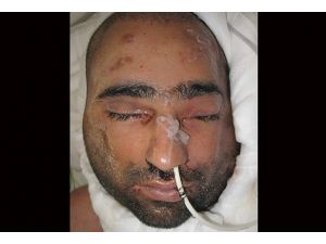 Yüz nakli yapılan Üslün'ün ilk fotoğrafı