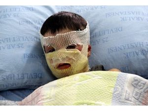 Karnından alınan deri yüzüne nakledildi