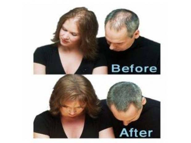 Nano Hair Saç Dökülmesine Karşı Çözüm