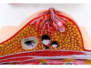 Kolesterol meme kanserinin büyümesini tetikleyebilir