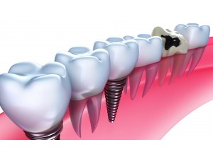 Bu Yöntem Çene Kemiğinizin Erimesini Engelliyor